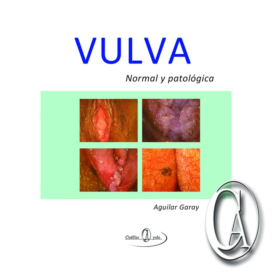 Lista Foto Im Genes Del Papiloma Humano En Mujeres Actualizar